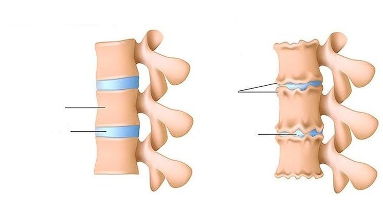 columna vertebral sa e columna vertebral afectada por osteocondrose