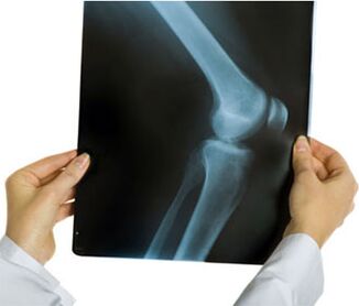 Radiografía para a artrose de xeonllo